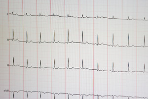 EKG