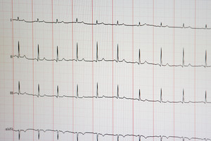 EKG